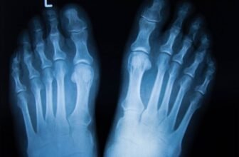 Uncommon Bone-Consuming Most cancers Changed Man’s Finger and Toe